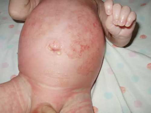 Эксфолиативный дерматит Риттера у новорожденных